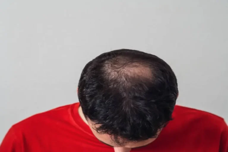 Hair fall
